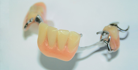 Conception de prothèse partielle (prothèse dentaire partielle amovible) Sainte-Rose | Hogan et Messier Denturologistes - Rosemère