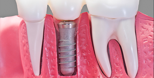 Pose d'implant dentaire (prothèse dentaire sur implant) Boisbriand | Hogan et Messier Denturologistes - Rosemère