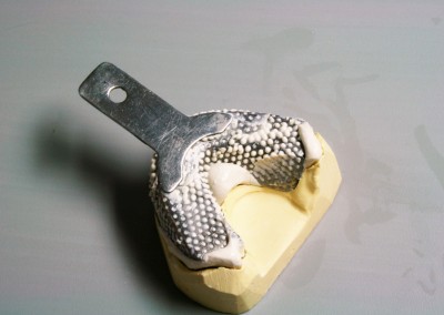 Couler empreinte primaire prothèse partielle inférieure (prothèse dentaire complète amovible) Rosemère | Hogan et Messier Denturologistes Rosemère