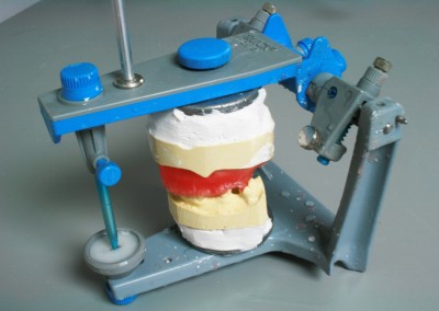 Mise en articulation sur articulateur prothèse complète supérieure (prothèse dentaire complète amovible) Sainte-Rose | Hogan et Messier Denturologistes - Rosemère