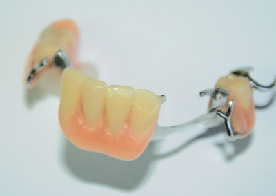 Prothèse dentaire partielle amovible (prothèse dentaire partielle amovible) Sainte-Thérèse | Hogan et Messier Denturologistes - Rosemère
