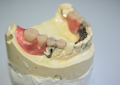 Prothèse dentaire partielle (prothèse dentaire complète amovible) Boisbriand | Hogan et Messier Denturologistes - Rosemère