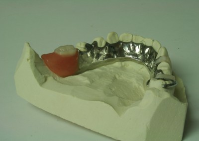 Prothèse partielle inférieure (prothèse dentaire partielle amovible) Blainville | Hogan et Messier Denturologistes - Rosemère
