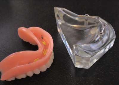 Conception de prothèse dentaire à implants (prothèse dentaire sur implants) Blainville | Hogan et Messier Denturologistes - Rosemère