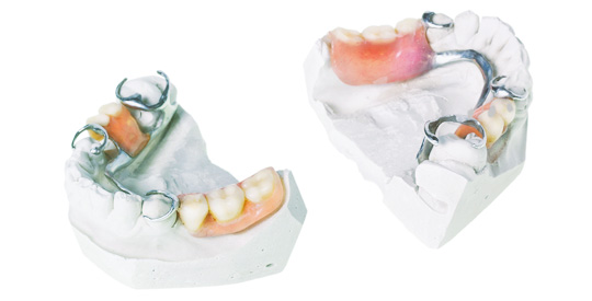 Prothèse dentaire partielle amovible - Hogan et Messier denturologistes