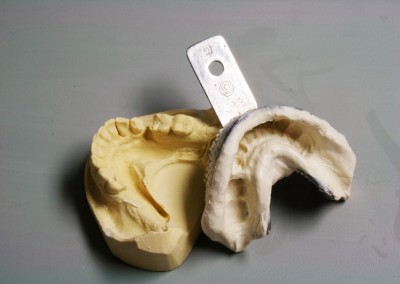 Modéle empreinte primaire prothèse partielle inférieure (prothèse dentaire complète amovible) Sainte-Thérèse | Hogan et Messier Denturologistes - Rosemère