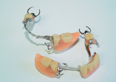 Prothèse dentaire partielle finale (prothèse dentaire complète amovible) Boisbriand | Hogan et Messier Denturologistes - Rosemère
