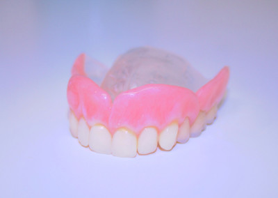 Prothèse complète (prothèse dentaire complète amovible) Sainte-Rose | Hogan et Messier Denturologistes - Rosemère