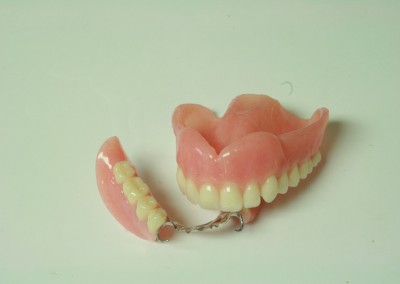 Prothèse complète supérieure sur partiel (prothèse dentaire complète amovible) Bois-des-Filion | Hogan et Messier Denturologistes - Rosemère