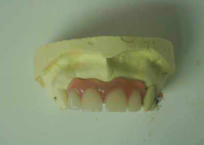 Prothèse partielle supérieure (prothèse dentaire partielle amovible) Blainville | Hogan et Messier Denturologistes Rosemère